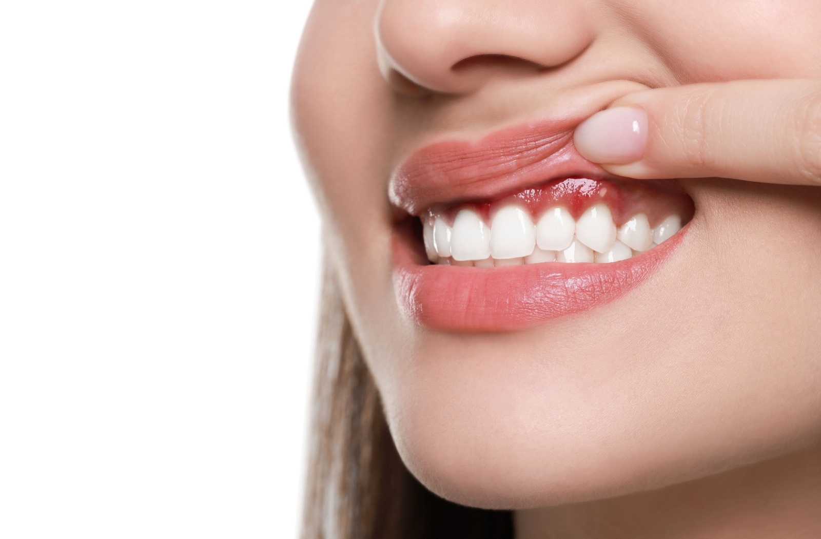 Close-up of a patient showing signs of gingivitis.